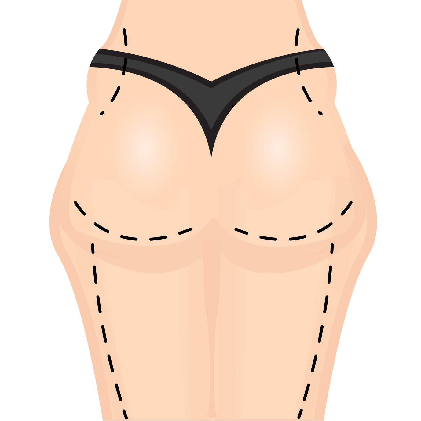 liposuction surgery