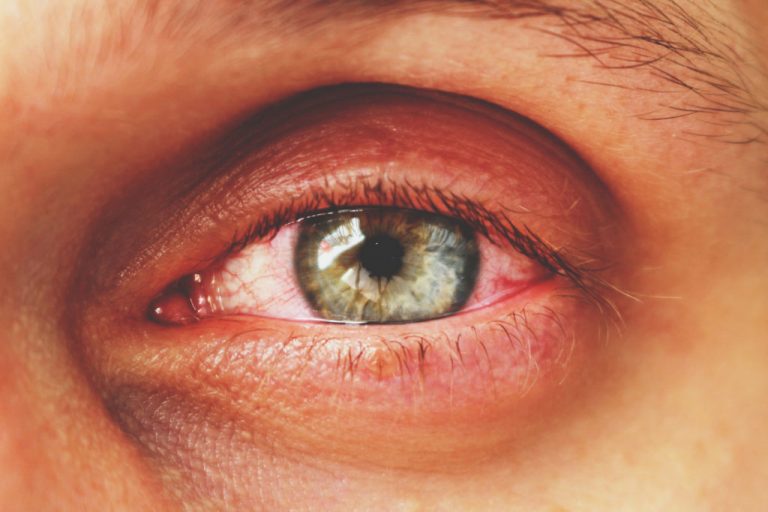 Red Eyes Complete Guide To Causes, Symptons, and Treatment